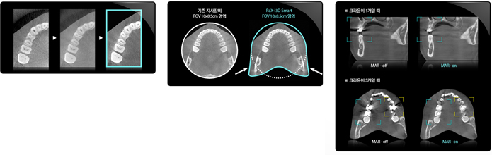 ŻCT :  PaX-i3D Smart / ġ ܿ ʿ CT, Pano, Cephalo  ϴ 3 in 1 System 
3D ˰
    籸    
   Arch FOV: Ǳ ¸   籸Ǿ  FOV        
   ΰ Auto MAR: ö Ư ° Metal Artifact  ڵ ٿ   ǰ  ȹ
2D ˰  
   Magic PAN: ĳ ü   (AF)  籸Ͽ  ǰ  ȹ 
