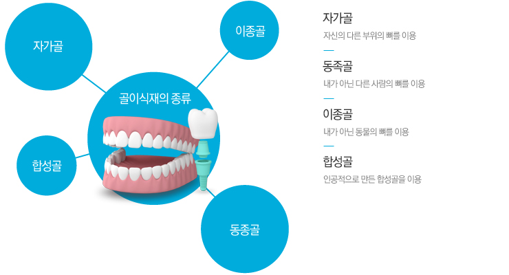 자가골:자신의 다른 부위의 뼈를 이용
동족골 : 내가 아닌 다른 사람의 뼈를 이용 
이종골 : 내가 아닌 동물의 뼈를 이용
합성골 : 인공적으로 만든 합성골을 이용
